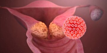 VPH debe ser prevenido desde la infancia