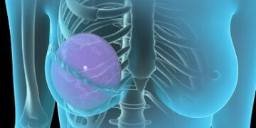 Buscan incorporar la reconstrucción mamaria en los servicios públicos de salud