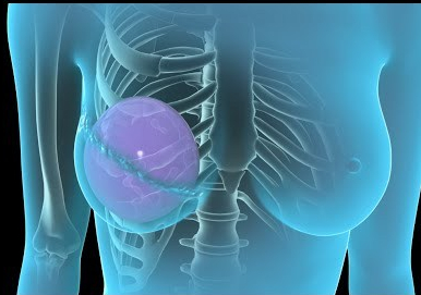 Buscan incorporar la reconstrucción mamaria en los servicios públicos de salud